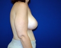 Breast lift pictures 1318.JPG
