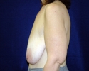 Breast lift pictures 1327.JPG