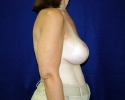 bBreast lift pictures 1330.JPG