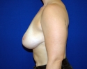 Breast lift pictures_photo_lift_1403.JPG