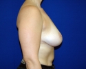 Breast lift pictures_photo_lift_1405.JPG