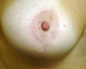 Breast lift pictures_photo_lift_1406.JPG