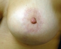 Breast lift pictures_photo_lift_1407.JPG