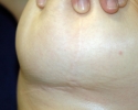 Breast lift pictures_photo_lift_1416.JPG