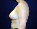 breast_implant_photo_lift_1509.JPG