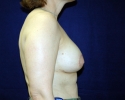 breast_implant_photo_lift_1512.JPG