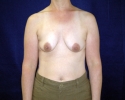 Periareolar mastopexy pictures_lift_1801.JPG