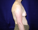 Periareolar mastopexy pictures_lift_1804.JPG