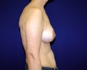 Periareolar mastopexy pictures_lift_1815.JPG