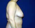 Breast lift pictures _301.JPG