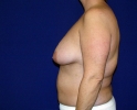 Breast lift pictures _303.JPG