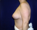 Breast lift pictures _309.JPG