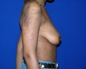 Breast lift pictures 207.JPG