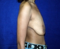 Breast lift pictures 109.JPG