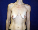 Breast lift pictures_implant_photo_lift_811.JPG