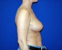 Breast lift pictures_photo_lift_909.JPG