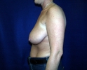Breast lift pictures_photo_lift_926.JPG