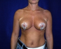 Breast lift pictures_photo_lift_935.JPG