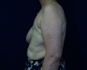 picture-breast-reconstruction-delayed-132b.JPG