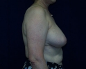 picture-breast-reconstruction-delayed-132c.JPG