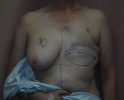picture-breast-reconstruction-delayed-132e.JPG
