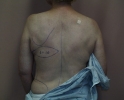picture-breast-reconstruction-delayed-132f.JPG