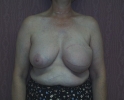 picture-breast-reconstruction-delayed-132g.JPG