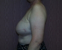 picture-breast-reconstruction-delayed-132h.JPG