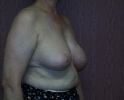 picture-breast-reconstruction-delayed-132i.JPG