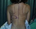 breast-reconstruction-back-flap-pictures-74g.jpg
