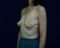 breast-reconstruction-back-flap-pictures-74j.jpg
