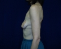 breast-reconstruction-back-flap-pictures-74k.jpg