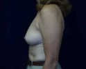 picture-breast-reconstruction-immediate89a.JPG