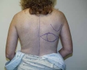 picture-breast-reconstruction-immediate89j.JPG