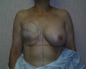 picture-breast-reconstruction-expander- 114d.jpg