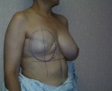 picture-breast-reconstruction-expander- 114e.jpg