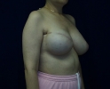 picture-breast-reconstruction-expander- 114g.jpg