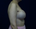 picture-breast-reconstruction-expander- 114h.jpg