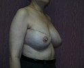 picture-breast-reconstruction-expander- 114l.jpg