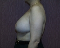 picture-breast-reconstruction-expander- 114o.jpg