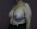 picture-breast-reconstruction-expander- 114p.jpg