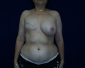 picture-breast-reconstruction-expander-114a.jpg