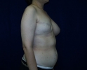 picture-breast-reconstruction-expander-114b.jpg