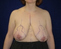 breast reduction markings_306.JPG
