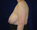 breast reduction markings photo_308.JPG