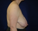 breast reduction markings photo_309.JPG