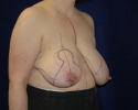 markings for breast reduction picture_310.JPG