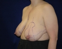 breast reduction markings photo_311.JPG