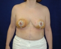 breast reduction one week after plastic surgery_312.JPG