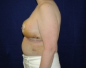 breast reduction picture 1 week after_315.JPG
